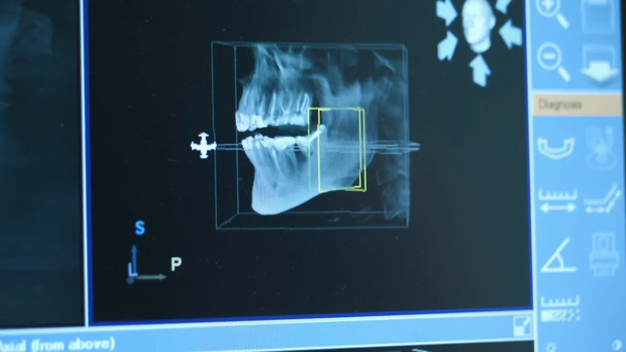 Planificación digital del tratamiento de implantes con TAC 3D