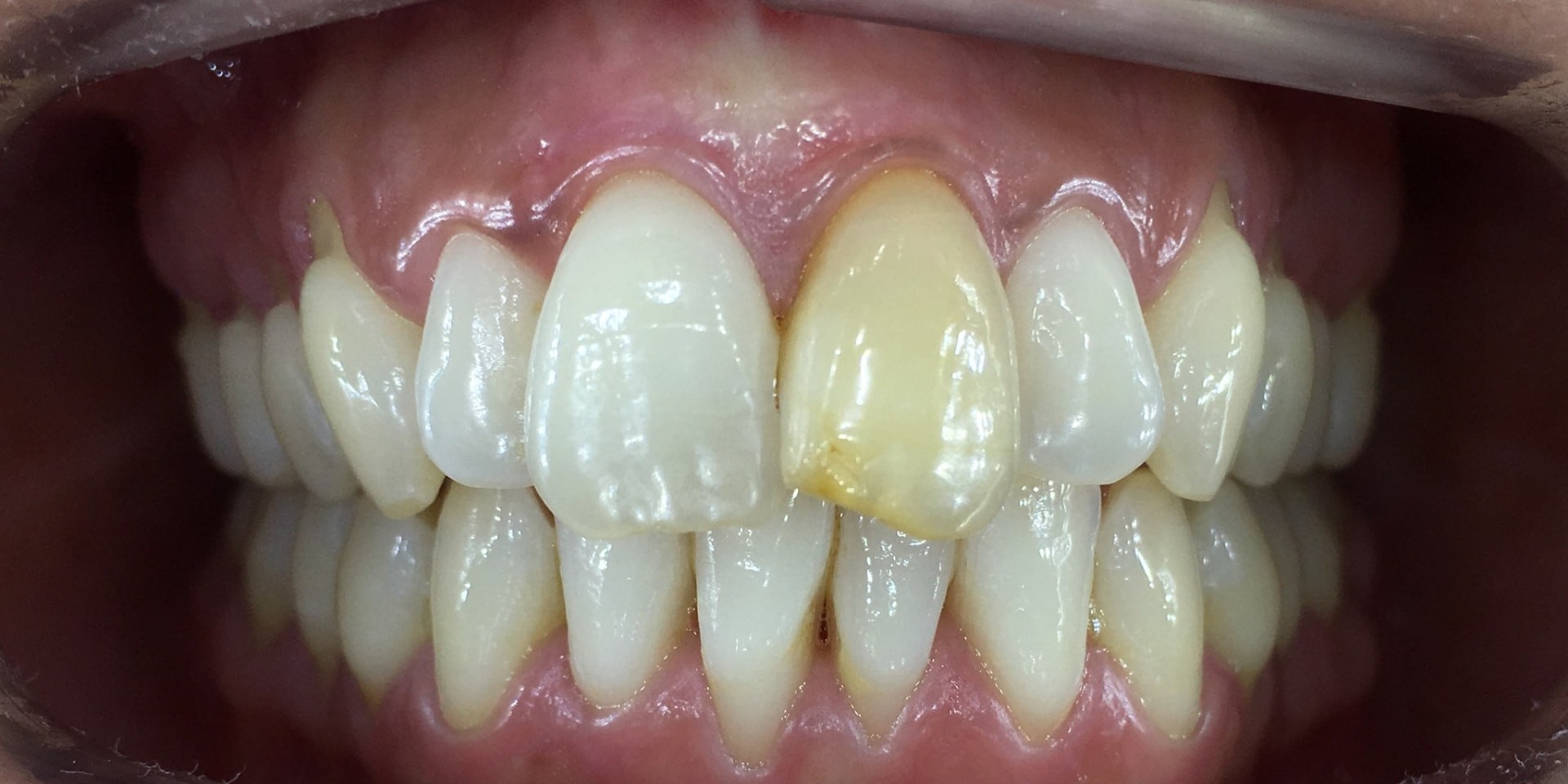 Intraoral antes del tratamiento estético