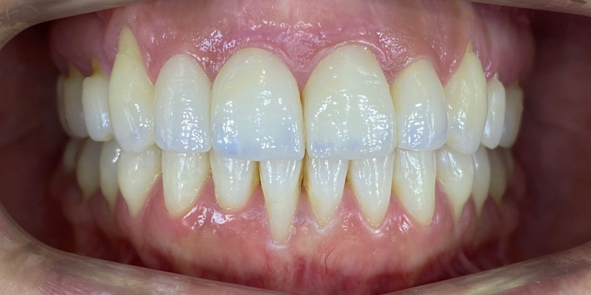 Intraoral después del tratamiento estético