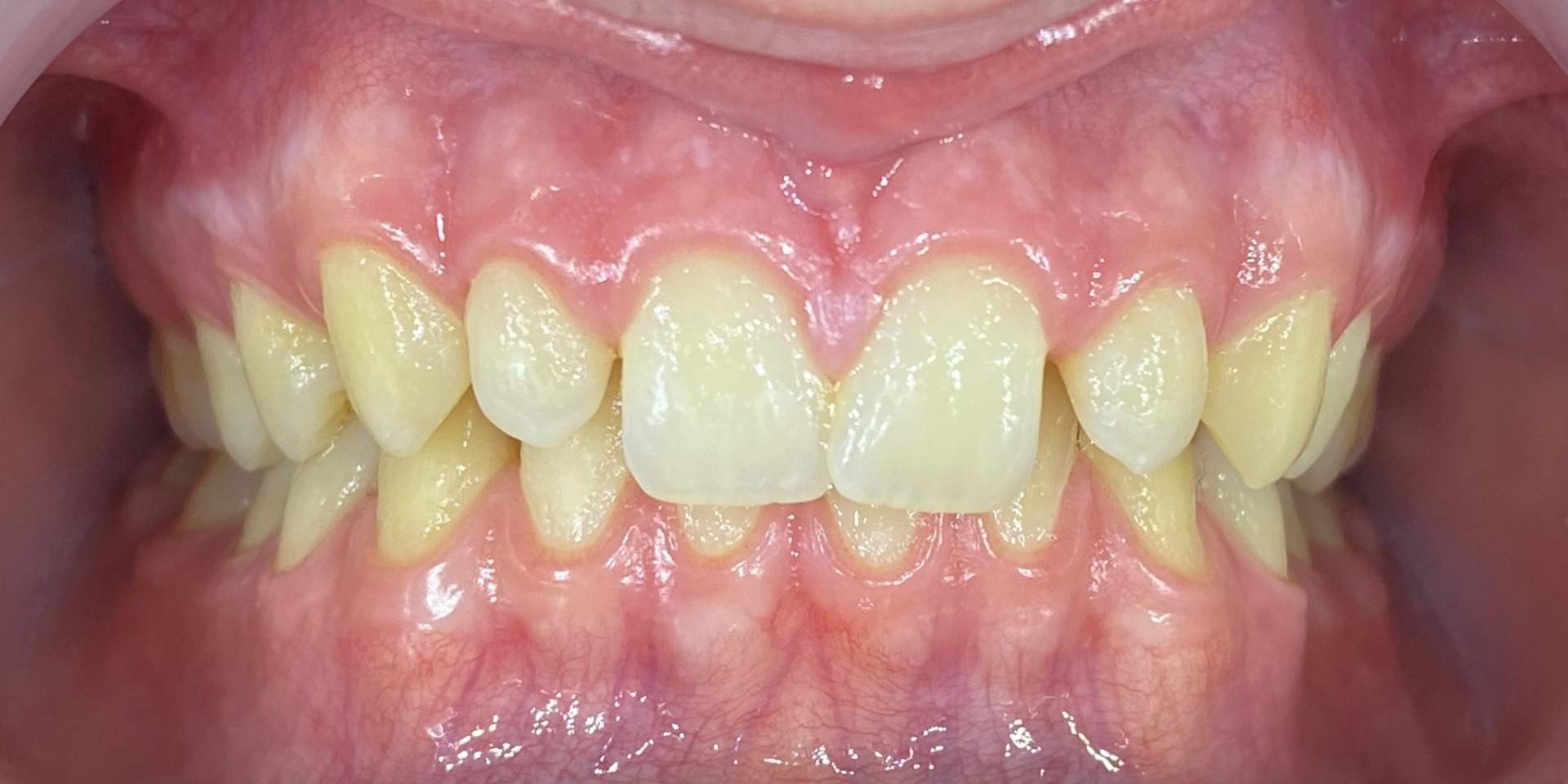 Intraoral antes del tratamiento estético