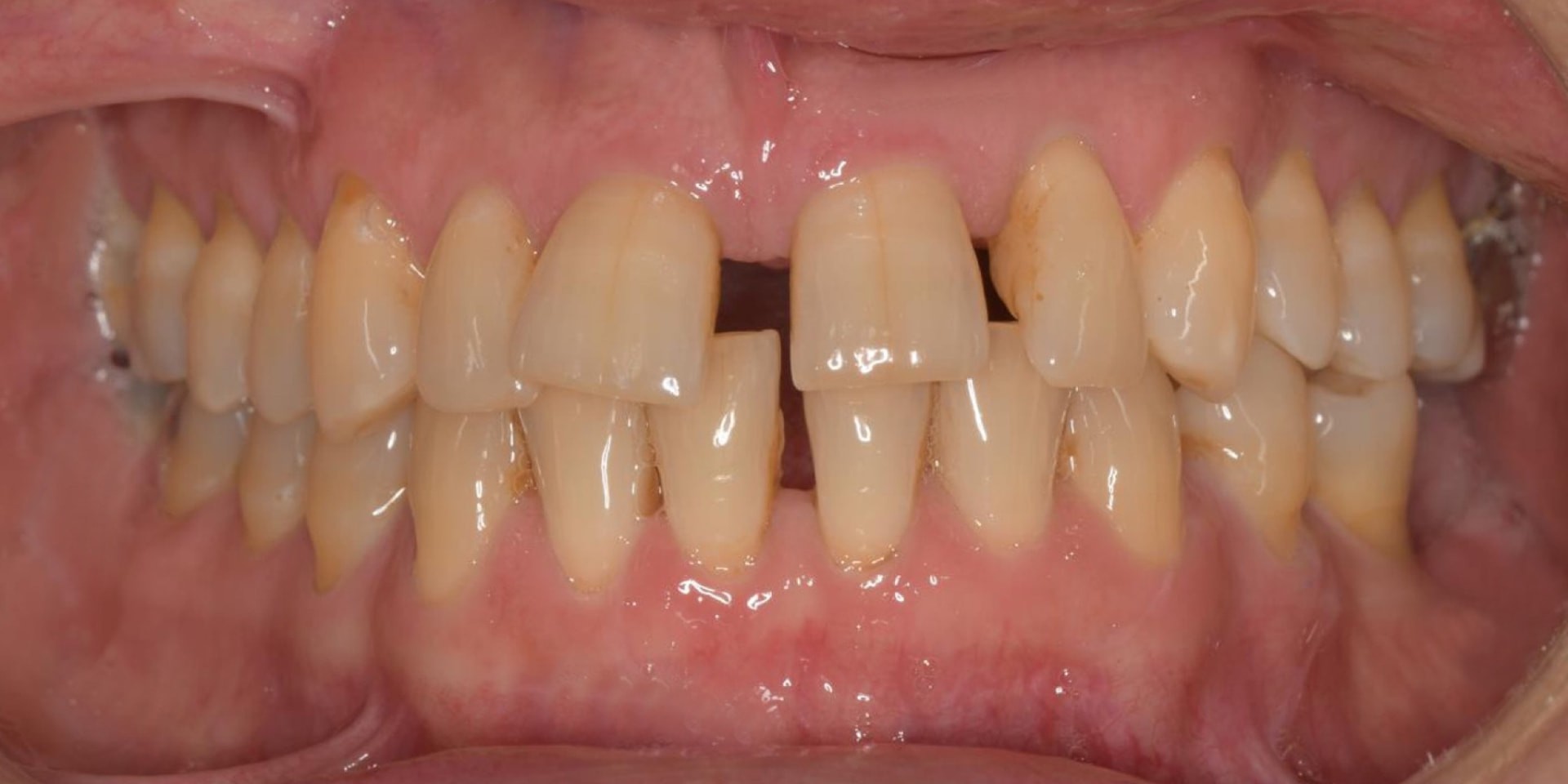Intraoral antes del tratamiento estético