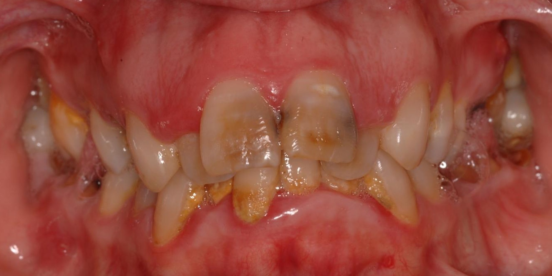 Vista frontal antes del tratamiento con implantes