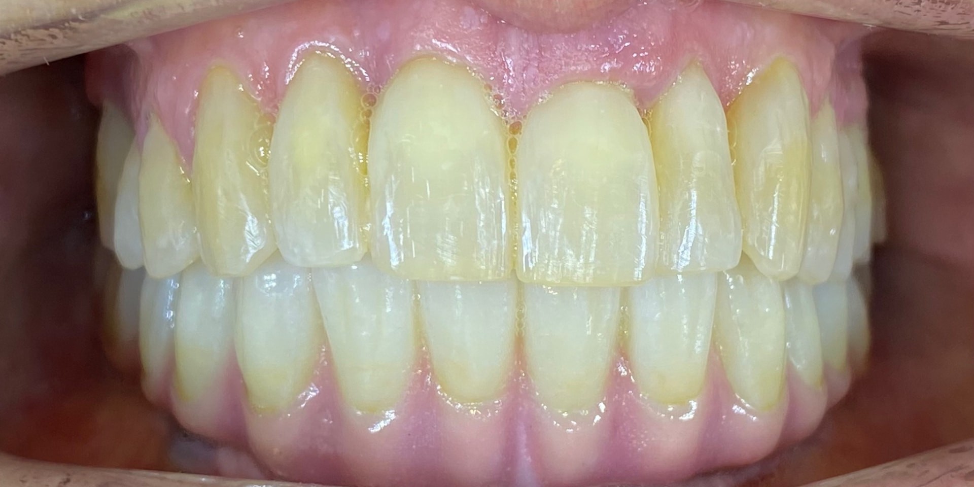 Vista frontal después del tratamiento con implantes