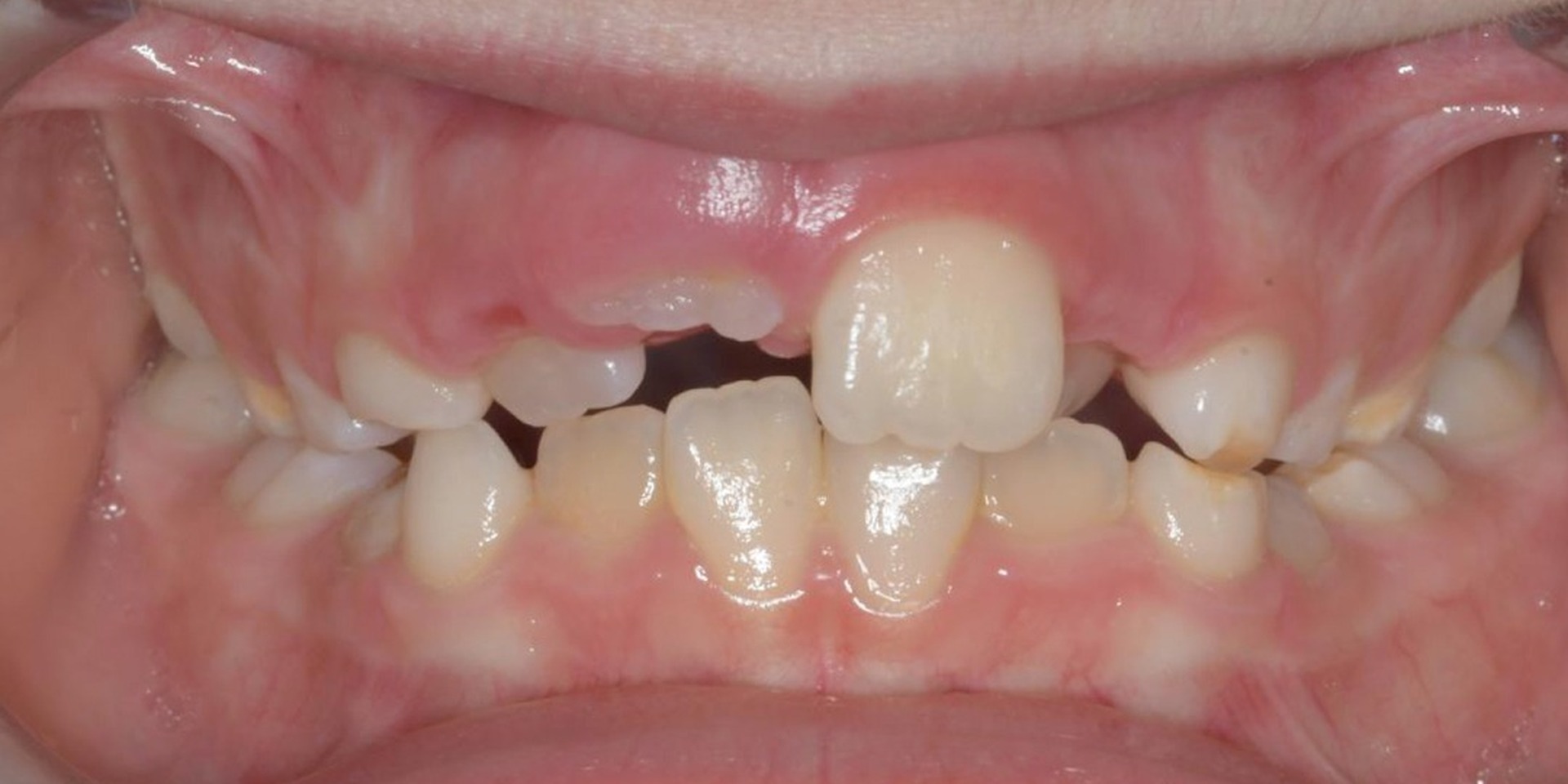 Frontal antes del tratamiento con alineadores