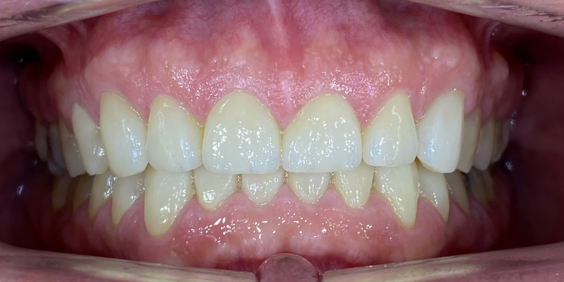 Intraoral después del tratamiento estético