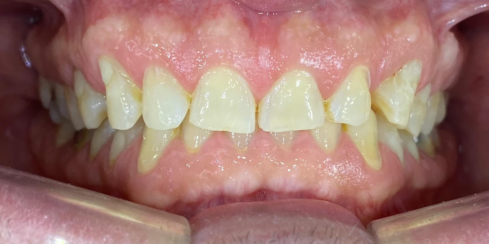 Intraoral antes del tratamiento estético