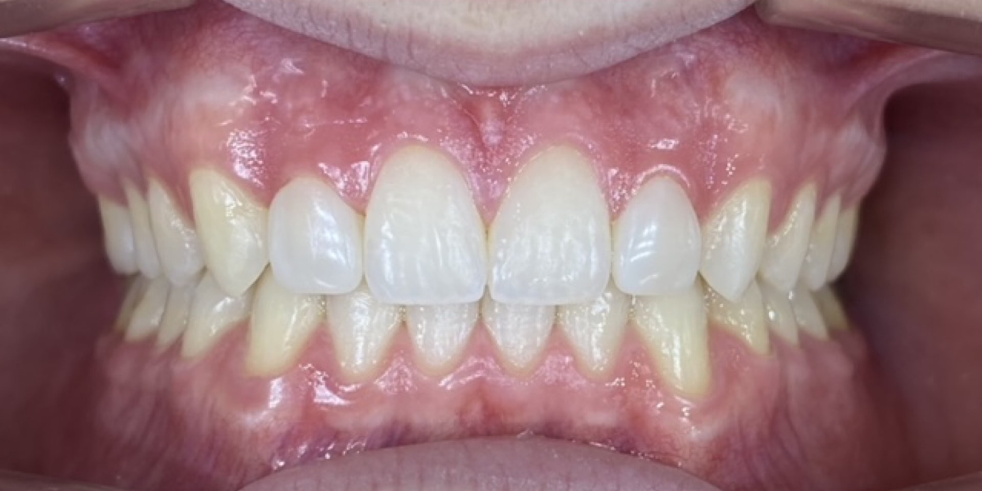 Intraoral después del tratamiento estético