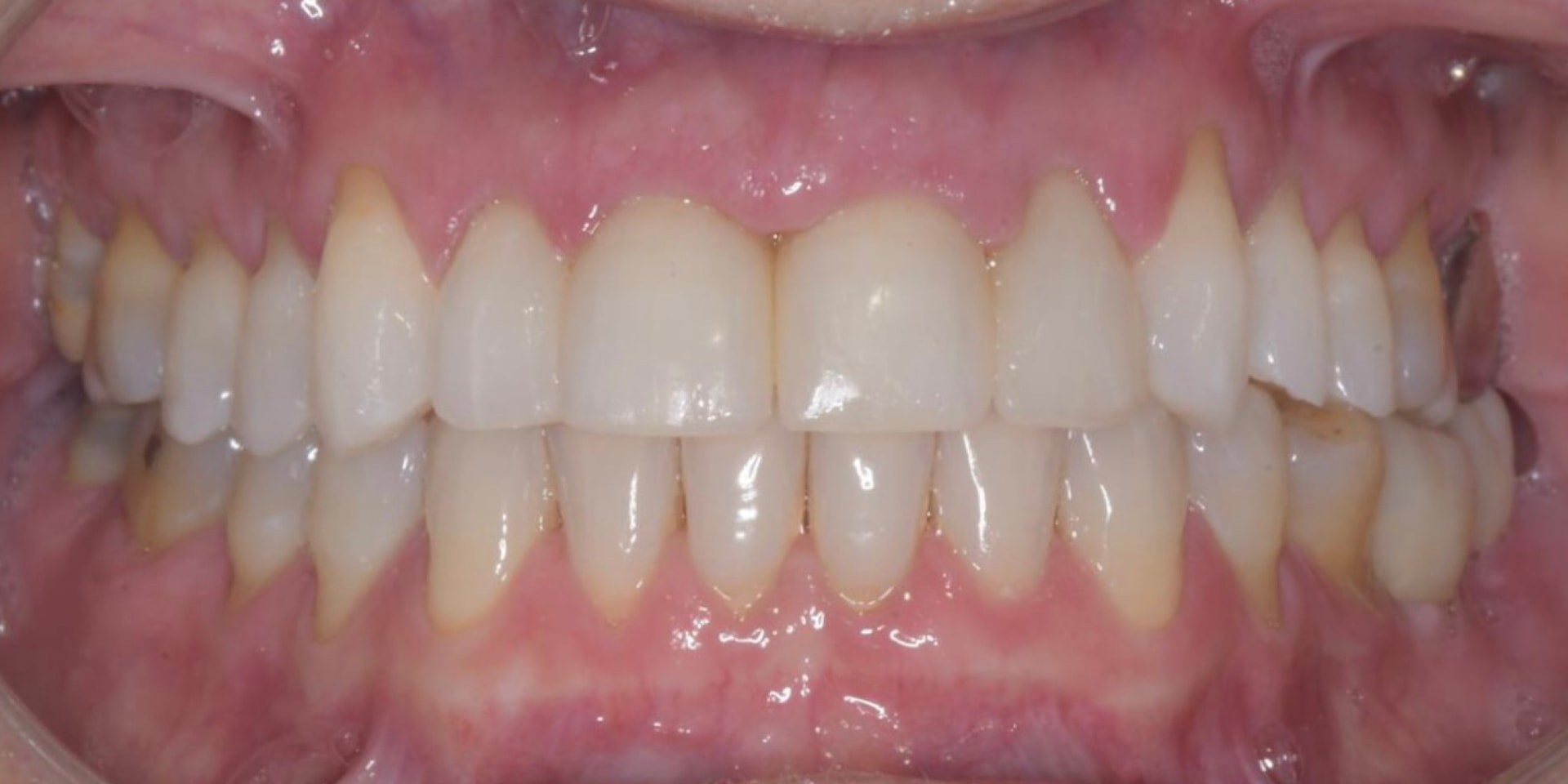 Intraoral después del tratamiento estético