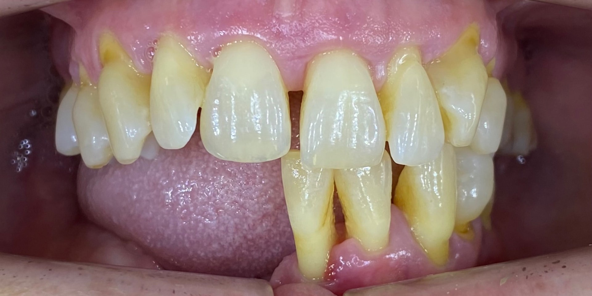 Vista frontal antes del tratamiento con implantes