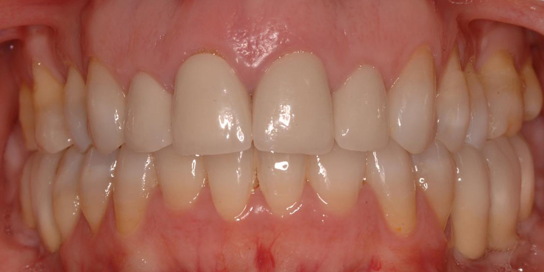 Vista frontal después del tratamiento con implantes